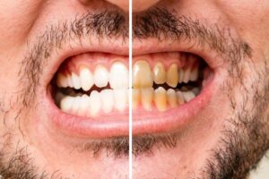 Teeth Discolouration